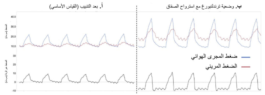 الشكل 2: موجات قياس الضغط المريئي لمريض يخضع للتهوية الميكانيكية أثناء إجراء جراحة بالمنظار. تُظهر الصورة أ مسارات ضغط المجرى الهوائي (ضغط المجرى الهوائي، الخط الأزرق)، والضغط المريئي (الضغط المريئي، الخط الأحمر)، والضغط عبر الرئة (الضغط عبر الرئة، الخط الرمادي) بعد التنبيب في وضعية الاستلقاء على الظهر عندما يبلغ ضغط نهاية الزفير الإيجابي 10 سم ماء. بينما تُظهر الصورة ب مسارات ضغط المجرى الهوائي (الخط الأزرق)، والضغط المريئي (الخط الأحمر)، والضغط عبر الرئة (الخط الرمادي) للمريض نفسه بعد تطبيق استرواح الصفاق ووضعية ترندلنبورغ عند ضغط نهاية زفير إيجابي يبلغ 10 سم ماء. في الصورة أ، يكون ضغط المجرى الهوائي والضغط المريئي متشابهين في نهاية الزفير، والضغط عبر الرئة يساوي صفرًا في نهاية الزفير (الخط المنقط). بعد النفخ ووضع المريض في وضعية ترندلنبورغ، يتجاوز الضغط المريئي ضغط المجرى الهوائي في نهاية الزفير، ما يؤدي إلى ضغط سلبي عبر الرئة أثناء الزفير (الخط المنقط)، وهي حالة مرتبطة بانخماص الرئة. (تم الحصول على إذن بالاستخدام من المؤلفين).