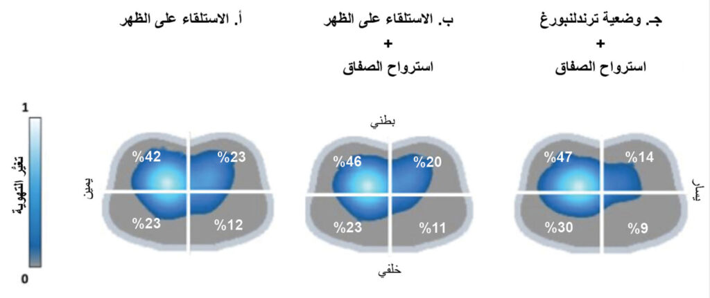 الشكل 3: صور تصوير المعاوقة الكهربائية (EIT) لتوزيع التهوية في الأرباع الأربعة أثناء إجراء جراحي بمساعدة الروبوت. تُظهر الصور التغيرات في التهوية عند مستوى ضغط نهاية الزفير الإيجابي نفسه خلال ثلاث مراحل مختلفة من الإجراء الجراحي؛ الصورة أ: بعد التنبيب في وضعية الاستلقاء على الظهر، والصورة ب: أثناء استرواح الصفاق في وضعية الاستلقاء على الظهر؛ والصورة ج: أثناء استرواح الصفاق ووضعية ترندلنبورغ. (تم الحصول على إذن بالاستخدام من المؤلفين).