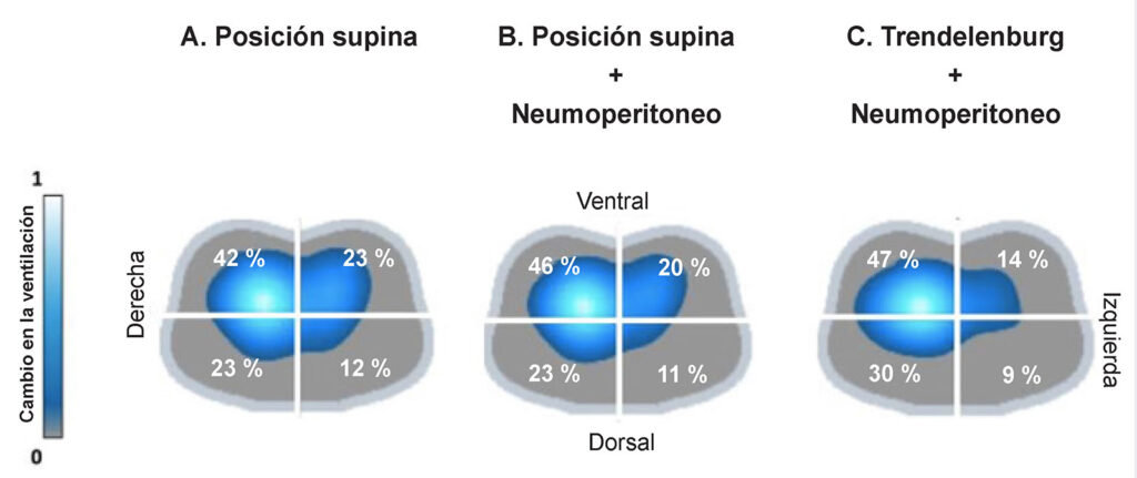 Figura 3: imágenes de EIT de la distribución de la ventilación en los cuatro cuadrantes durante un procedimiento asistido por robot. En los paneles se muestran los cambios en la ventilación al mismo nivel de la PEEP durante tres fases diferentes del procedimiento; Panel A: después de la intubación en posición supina, Panel B: durante el neumoperitoneo en posición supina, Panel C: durante el neumoperitoneo y la posición de Trendelenburg. (Se usa con permiso de los autores).