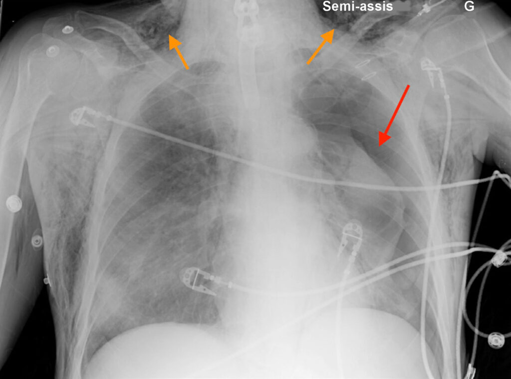 Figure 2 : Radiographie thoracique d’un patient présentant un mauvais positionnement de la canule de trachéotomie qui a reçu une ventilation en pression positive, entraînant un pneumothorax côté gauche (flèche rouge) et un emphysème sous-cutané (flèches orange) dans le cou.