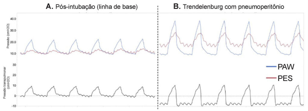 Figura 2: Curvas de manometria de pressão esofágica registradas em um paciente em ventilação mecânica durante um procedimento laparoscópico. O painel A mostra os traços para pressão nas vias aéreas (Pva, linha azul), pressão esofágica (Pes, linha vermelha) e pressão transpulmonar (PL, linha cinza) após intubação na posição supina na PEEP 10 cmH₂O. O painel B mostra os traços para Pva (linha azul), Pes (linha vermelha) e PL (linha cinza) para o mesmo paciente após pneumoperitônio e posicionamento de Trendelenburg em PEEP 10 cmH₂O. No Painel A, Pva e Pes são semelhantes no final da expiração, e PL é igual a zero no final da expiração (linha pontilhada). Após a insuflação e o posicionamento de Trendelenburg, a Pes excede a Paw no final da expiração, resultando em uma PL negativa durante a expiração (linha pontilhada), condição associada a colapso pulmonar. (Usado com a permissão dos autores.)