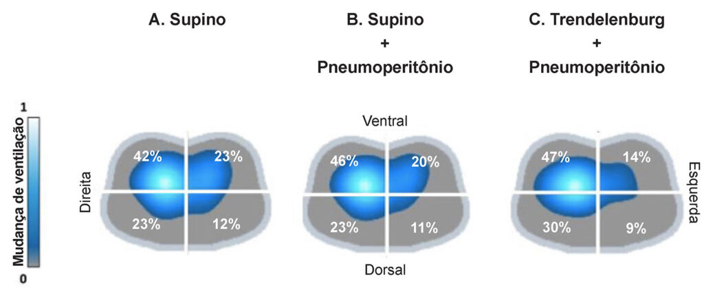 Figura 3: Imagens de TIE da distribuição da ventilação nos quatro quadrantes durante um procedimento assistido por robô. Painéis mostram as mudanças na ventilação no mesmo nível de PEEP durante três fases diferentes do procedimento: Painel A: após intubação em posição supina; Painel B: durante pneumoperitônio em posição supina; Painel C: durante pneumoperitônio e posição de Trendelenburg. (Usado com a permissão dos autores.)