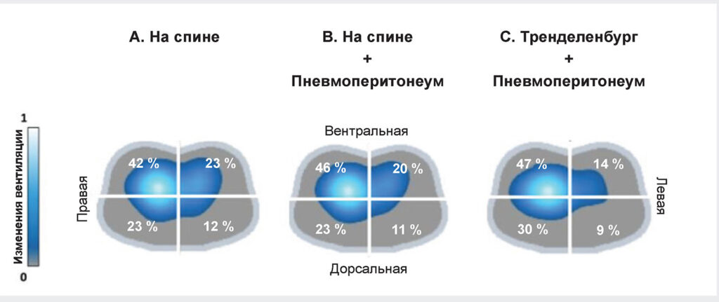 Рис. 3. Изображения ЭИТ, на которых показано распределение вентиляции в четырех квадрантах легких во время роботизированной операции. На панелях показаны изменения вентиляции при одинаковом уровне PEEP на трех разных этапах процедуры: панель A — после интубации в положении лежа на спине, панель B — во время пневмоперитонеума в положении лежа на спине, панель C — во время пневмоперитонеума в положении Тренделенбурга. (Используется с разрешения, полученного авторами.)