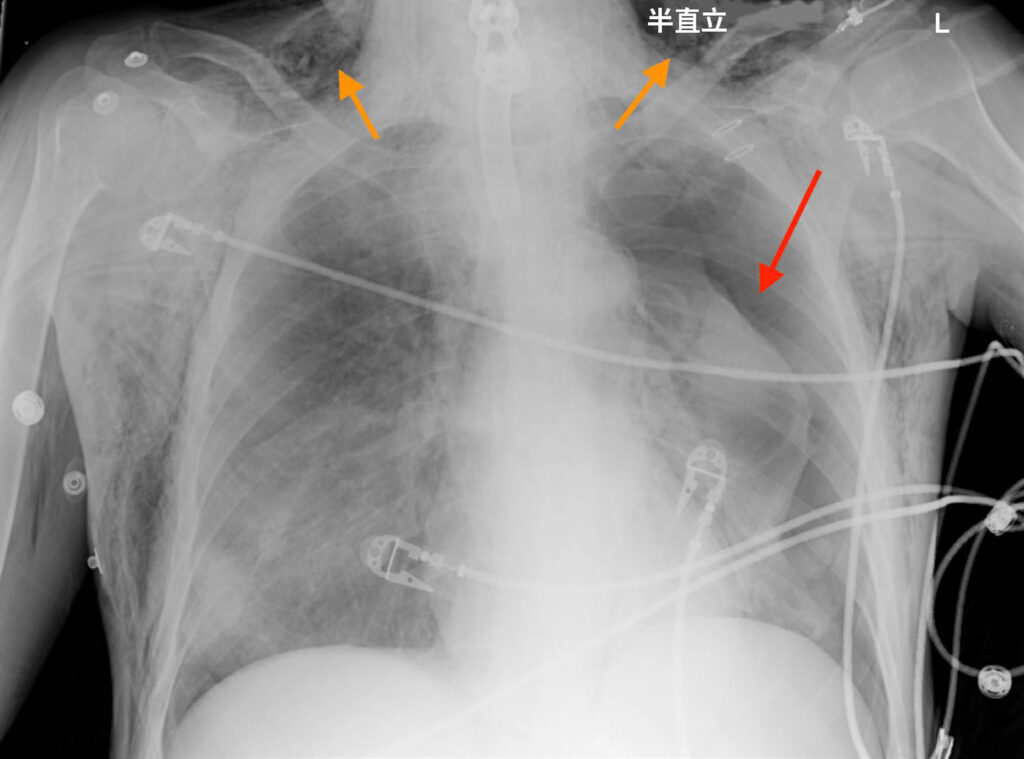 图 2：一例气管造口管位置不正确的患者的胸部 X 光片，其因接受正压通气而导致左侧气胸（红色箭头）和颈部皮下气肿（橙色箭头）。