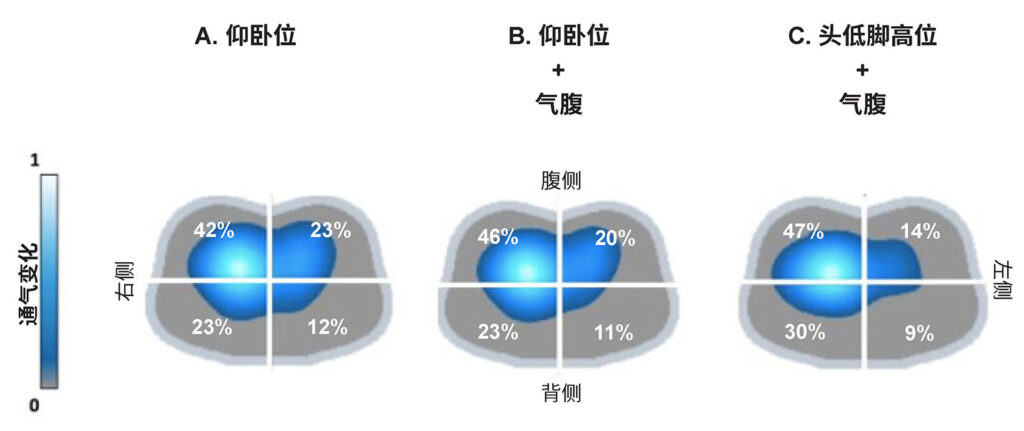 图 3:机器人辅助手术期间四个象限中通气分布的 EIT 图像。图中显示了在手术的三个不同阶段相同 PEEP 水平下的通气变化;图 A:仰卧位插管后;图 B:仰卧位气腹期间;图 C:气腹和头低脚高位期间。(经作者许可使用。)