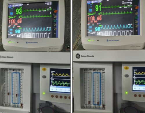 Beware of Semiquantitative Mainstream Carbon Dioxide Sensors in the Operating Room