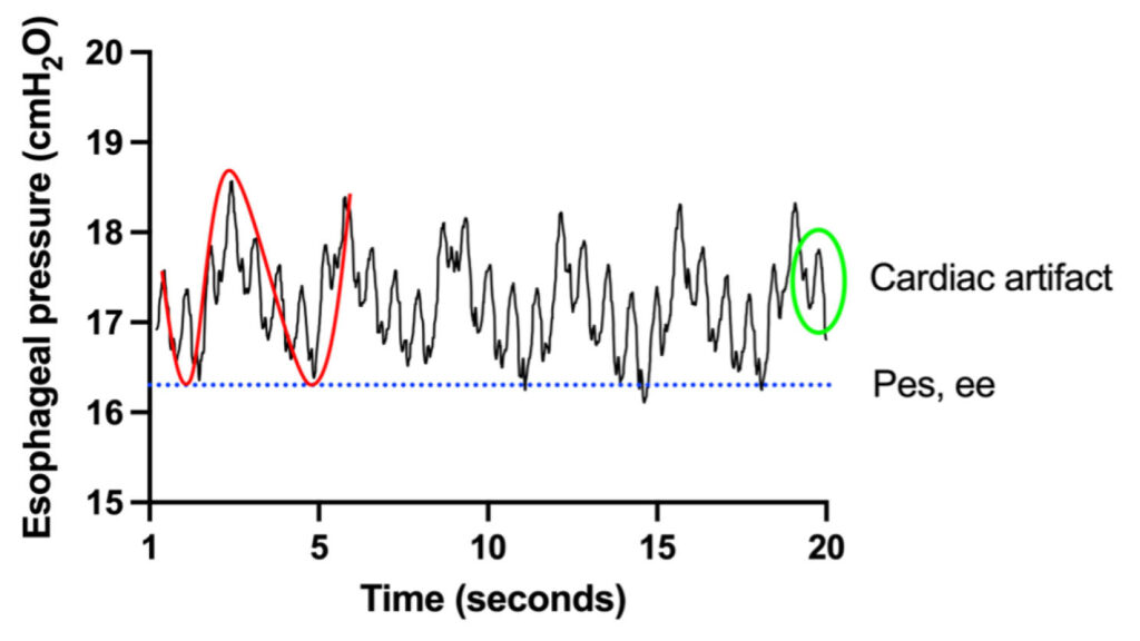 Figure 1: Esophageal pressure waveform recorded in a mechanically ventilated patient with a BMI of 67 kg/m². The red line represents the esophageal pressure trace, while the blue dotted line marks the end-expiratory esophageal pressure (Pes,ee). The green circle highlights cardiac artifacts. (Used with permission of the authors.)