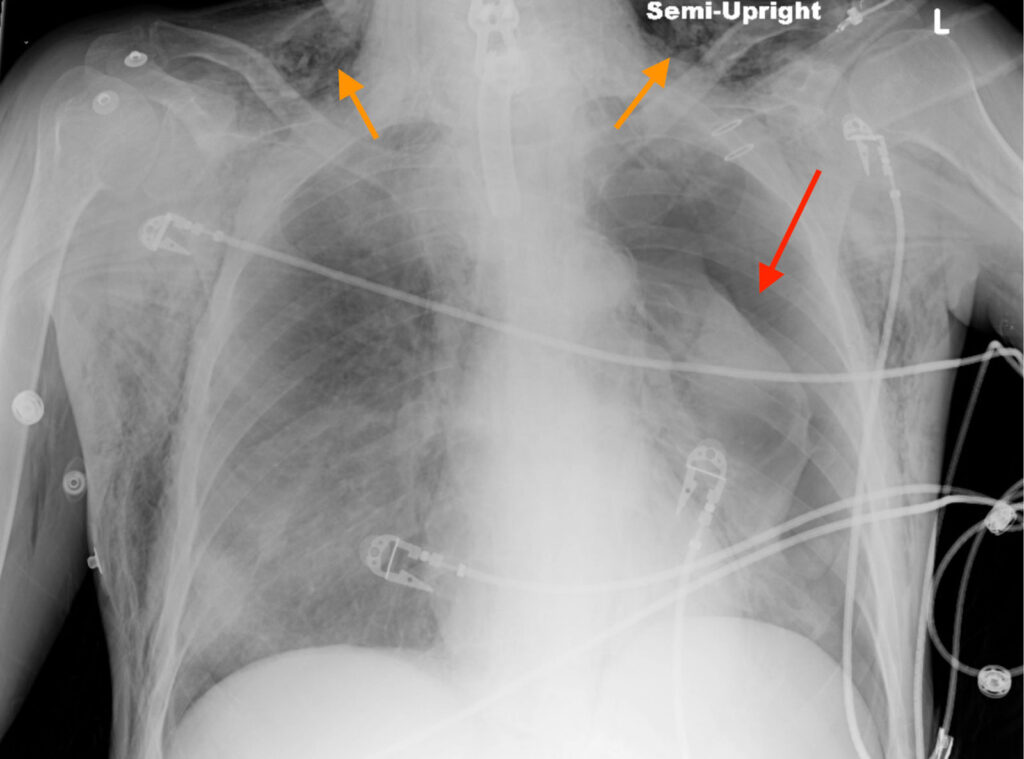 Figure 2: Chest x-ray from a patient with a malpositioned tracheostomy tube who received positive pressure ventilation, leading to a left-sided pneumothorax (red arrow) and subcutaneous emphysema (orange arrows) in the neck.