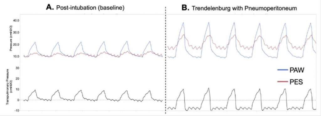 Figure 2: Esophageal pressure manometry curves recorded in a mechanically ventilated patient during a laparoscopic procedure. Panel A shows the traces for airway pressure (Paw, blue line), esophageal pressure (Pes, red line), and transpulmonary pressure (PL, grey line) after intubation in the supine position at PEEP 10 cmH₂O. Panel B shows the traces for Paw (blue line), Pes (red line), and PL (grey line) for the same patient after pneumoperitoneum and Trendelenburg positioning at PEEP 10 cmH₂O. In Panel A, Paw and Pes are similar at end-expiration, and PL equals zero at end-expiration (dotted line). After insufflation and Trendelenburg positioning, Pes exceeds Paw at end-expiration, resulting in a negative PL during expiration (dotted line), a condition associated with lung collapse. (Used with permission of the authors.)