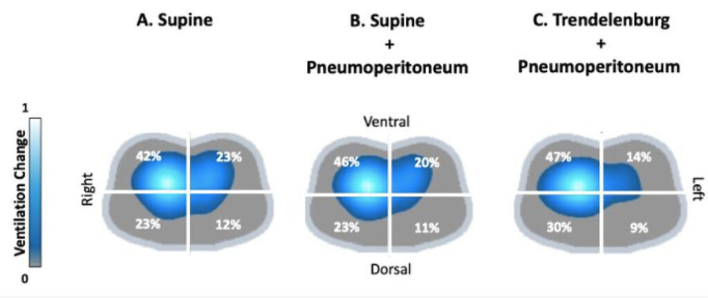 Figure 3: EIT images of ventilation distribution in the four quadrants during a robotic-assisted procedure. Panels show the changes in ventilation at the same PEEP level during three different phases of the procedure; Panel A: after intubation in supine position, Panel B during pneumoperitoneum in supine position; Panel C: during pneumoperitoneum and Trendelenburg position. (Used with permission of the authors.)