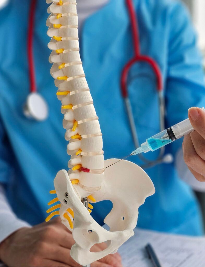 A syringe placed at the base of the spine