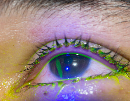 Managing Corneal Abrasions: A PACU Protocol for Anesthesiology Teams