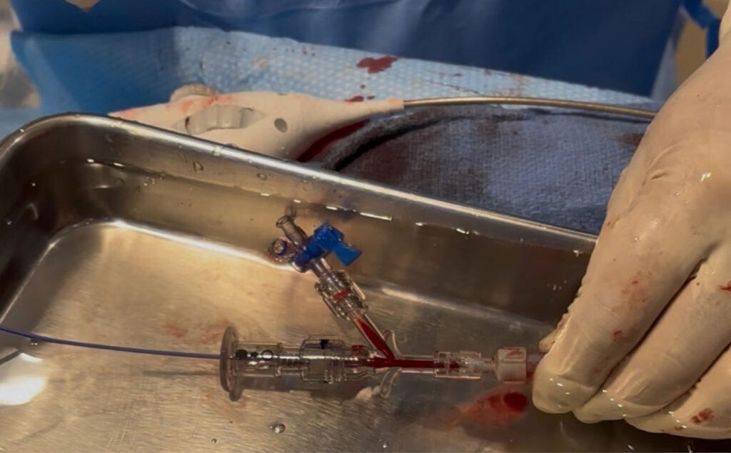 Figure 1: The proceduralist holds the delivery sheath connected to a Tuohy-Borst hemostatic valve with side-port stopcock. A pigtail catheter (left,} is coursing through the valve to access the left atrium. During device exchange, the connection is kept submerged under sterile water in a basin while the system is briefly disconnected to attach the Watchman delivery device.