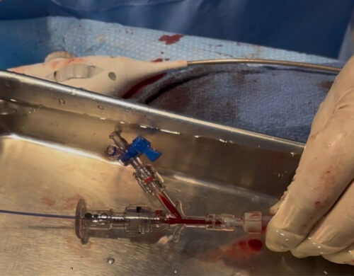 A proceduralist holds the delivery sheath connected to a Tuohy-Borst hemostatic valve with side-port stopcock