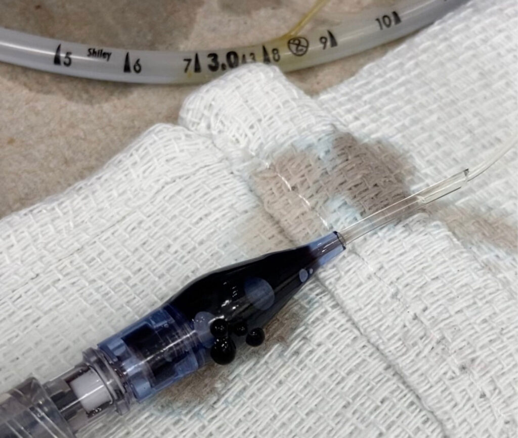 Figure 3. Leaks in the pilot balloon or pilot line. This endotracheal tube was identified after testing to have leaks in the mechanism to inflate the pilot balloon. Dye was used to aid in visualization.