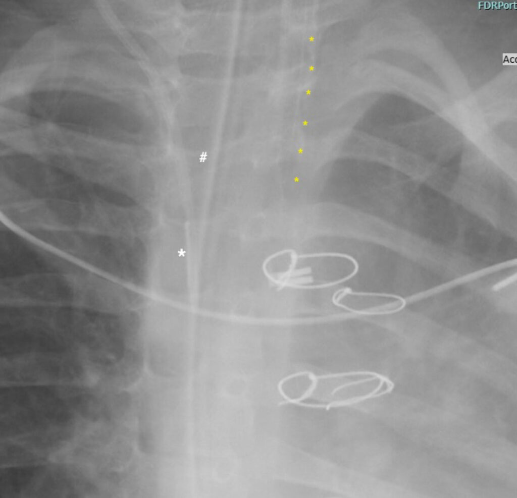 Figure 5. Radiopaque markers. This magnified image of a postoperative chest x-ray in a child following cardiac surgery was read by radiology as extubated due to the faint markers on this brand of endotracheal tube. White * - central venous line; White # - gastric tube; Yellow • - the endotracheal tube marker