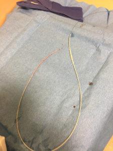 Figure 2 – Section of lumbar drain catheter after removal from patient which demonstrates lengthwise contraction.