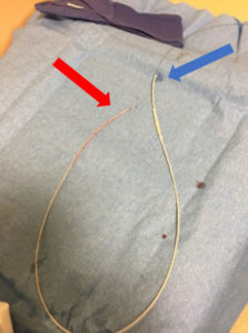 Figure 3 – Lumbar drain catheter containing guidewire after removal from patient. Guidewire and catheter are aligned at proximal end (red arrow). Catheter is contracted along wire at distal end (blue arrow).