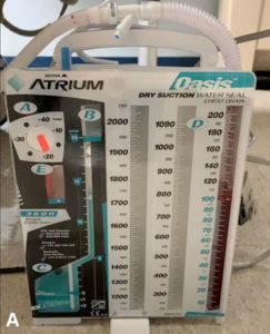 <strong>A.</strong> An example of a chest tube apparatus commonly used in the operating room. Section A denotes dry suction control, preset at -20mm H<sub>2</sub>O, yet can be adjusted to any setting between -10 and -40mm H<sub>2</sub>O. Section B denotes the water seal chamber. Section C is a water seal monitor, where air bubbles are created in the presence of an air leak. Section D is a collection chamber, into which the fluid from the patient is collected and measured. Section E is an expandable orange bellows that is deflated in the absence of suction.