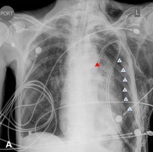 <strong>A.</strong> Immediate post-operative AP view. Endotracheal tube in place, with tip above the carina. Left chest tube with suction applied, with tip properly projecting over the medial aspect of the left upper lung (red arrow). Moderate-sized left pneumothorax (white arrows) with some mass effect and mild shift to the right side; extensive subcutaneous emphysema present.