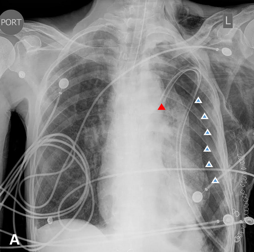 pneumothorax chest tube