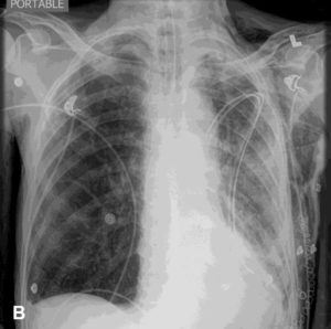 <strong>B.</strong> AP view, two hours after initial chest x-ray shown in part A. Endotracheal tube placement unchanged. Interval expansion of left lung with no visible pneumothorax. Marked soft tissue emphysema over the entire left hemi-thorax and thoracic inlet.