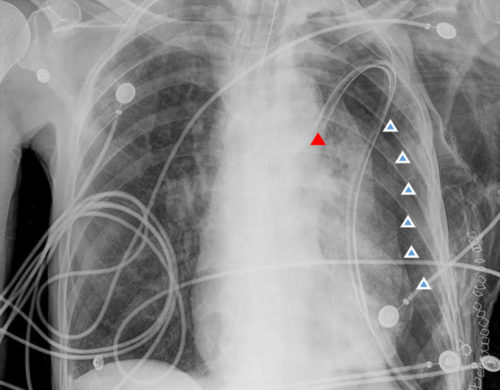 Endotracheal Tube X-ray