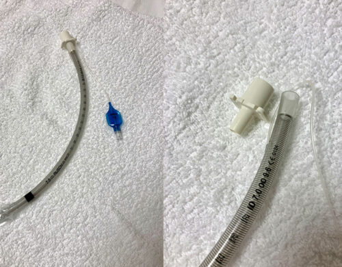 Armored endotracheal tube with universal connector detached revealing adhesive remnant, previously used to bind universal connector to endotracheal tube