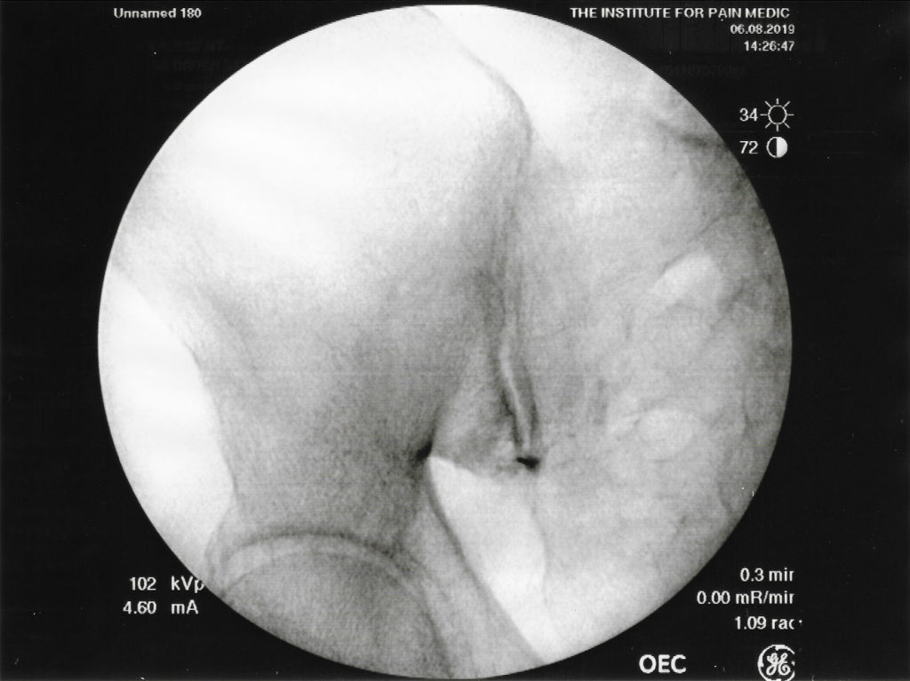 Figure 1: Fluoroscopy of the right sacroiliac joint with gadolinium contrast media