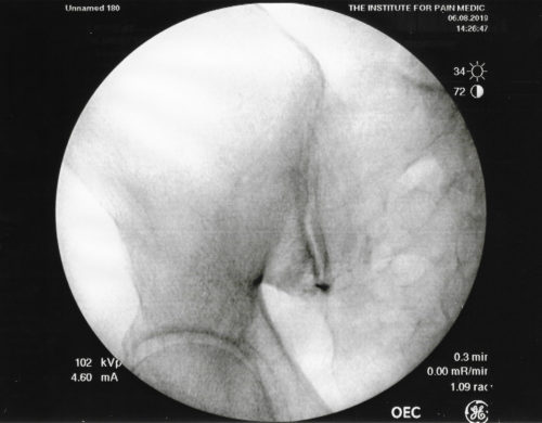 Fluoroscopy of the right sacroiliac joint with gadolinium contrast media