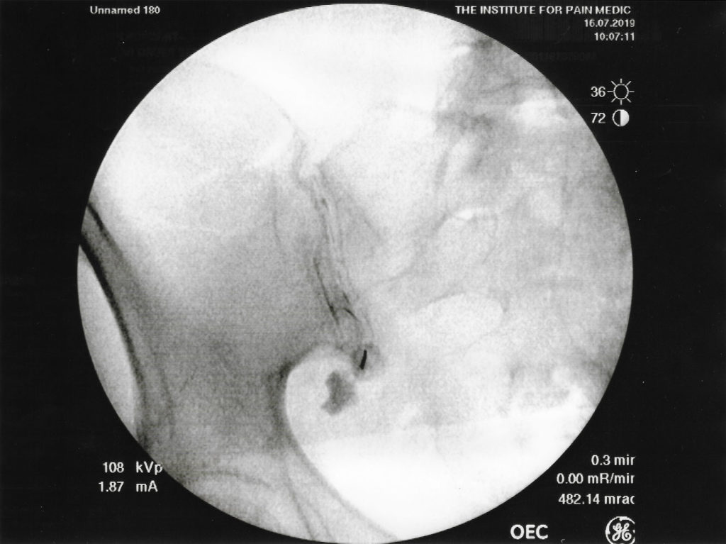 Figure 2: Fluoroscopy of the right sacroiliac joint with iodinated contrast media