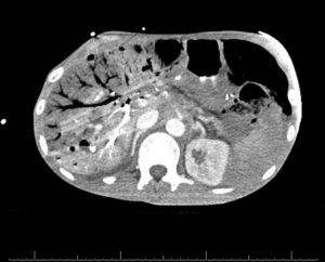 Figure 1: Shows large amounts of intra hepatic venous air with small foci of pneumoperitoneum. The pattern of air seen in hepatic venous gas extends to within 2 cm of the liver capsule.