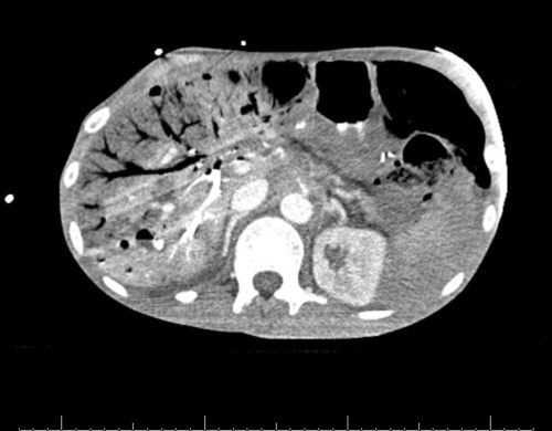 Large amounts of intra hepatic venous air with small foci of pneumoperitoneum