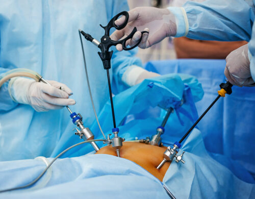 Laparoscopic Surgery