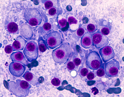 Multiple Myeloma Plasma Cell Malignancy