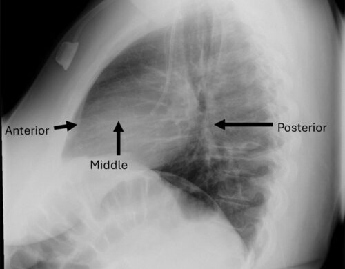 Anesthetic Considerations for the Management of Patients with Anterior Mediastinal Mass