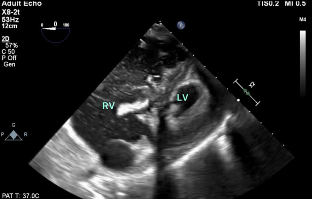 Figure 1. Trans-gastric basal short-axis view reveals a dilated right ventricle containing multiple hyperechoic shadows consistent with the appearance of emboli, and a severely underfilled and hyperdynamic left ventricle.