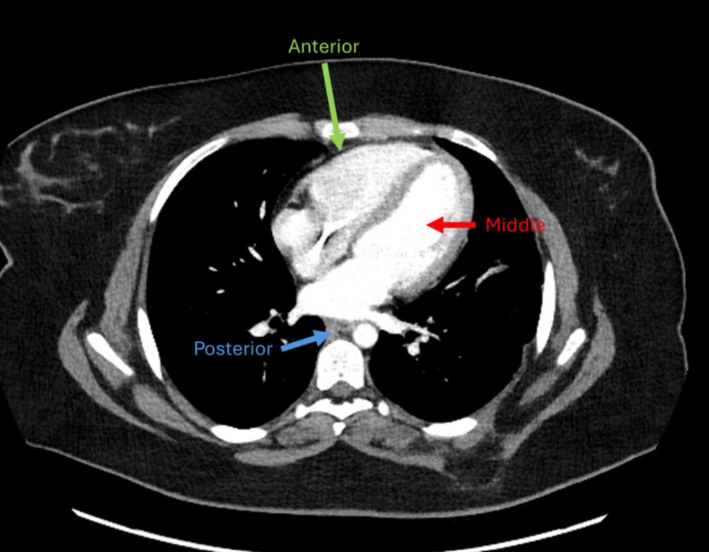 Figure 3. Computed Tomography (CT) chest, axial section demonstrates anterior (prevascular), middle (visceral), and posterior (paravertebral) mediastinum.