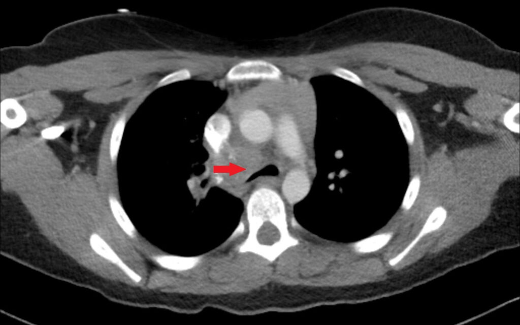 Figure 5. Chest CT of a 13-year-old demonstrates a right paratracheal soft tissue mass with associated tracheal compression.
