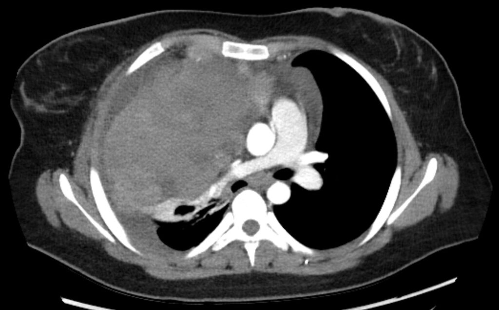 Figure 6. Chest CT of a 17-year-old with an anterior mediastinal mass with central airway and central vascular compression associated with the bulk disease, which raises concern for airway compromise.